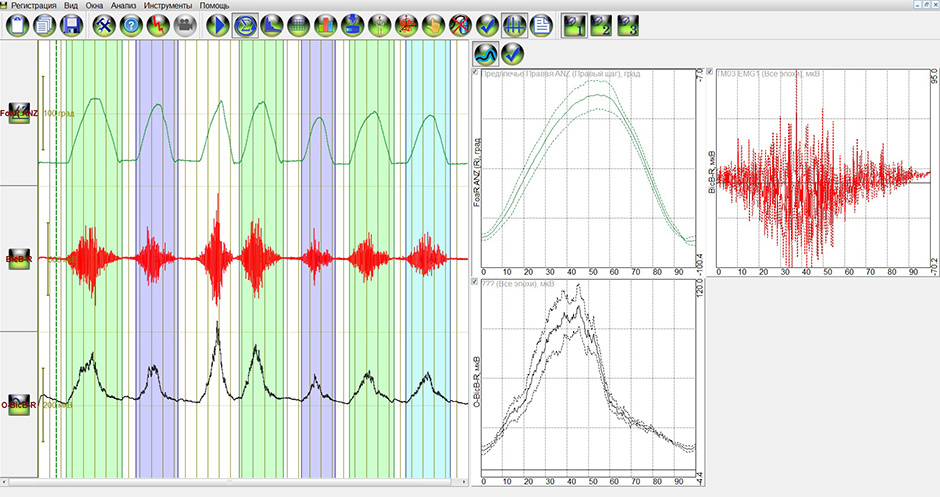 Рис. 4. Экран исследования – слева отмеченные временные эпохи, справа графики: гониограмма, нативная ЭМГ, огибающая ЭМГ.